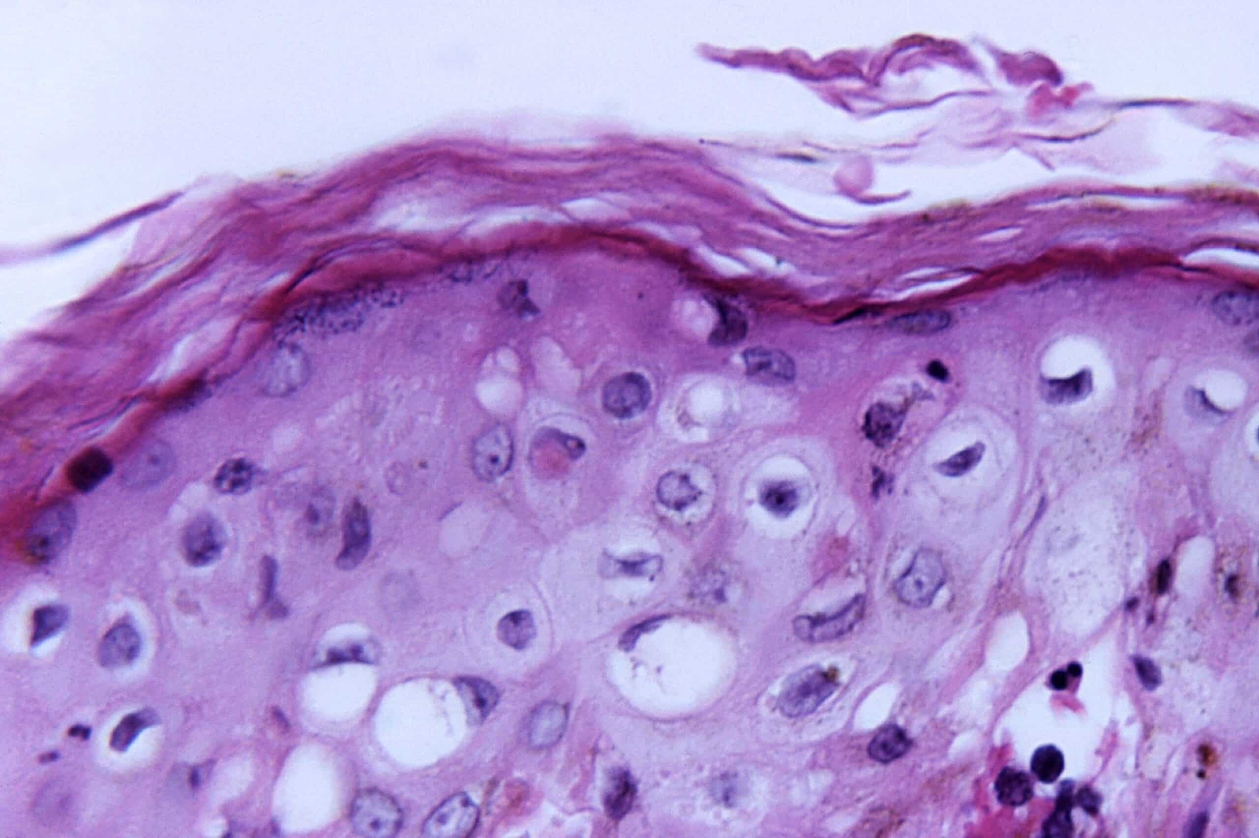 biofilms in the skin