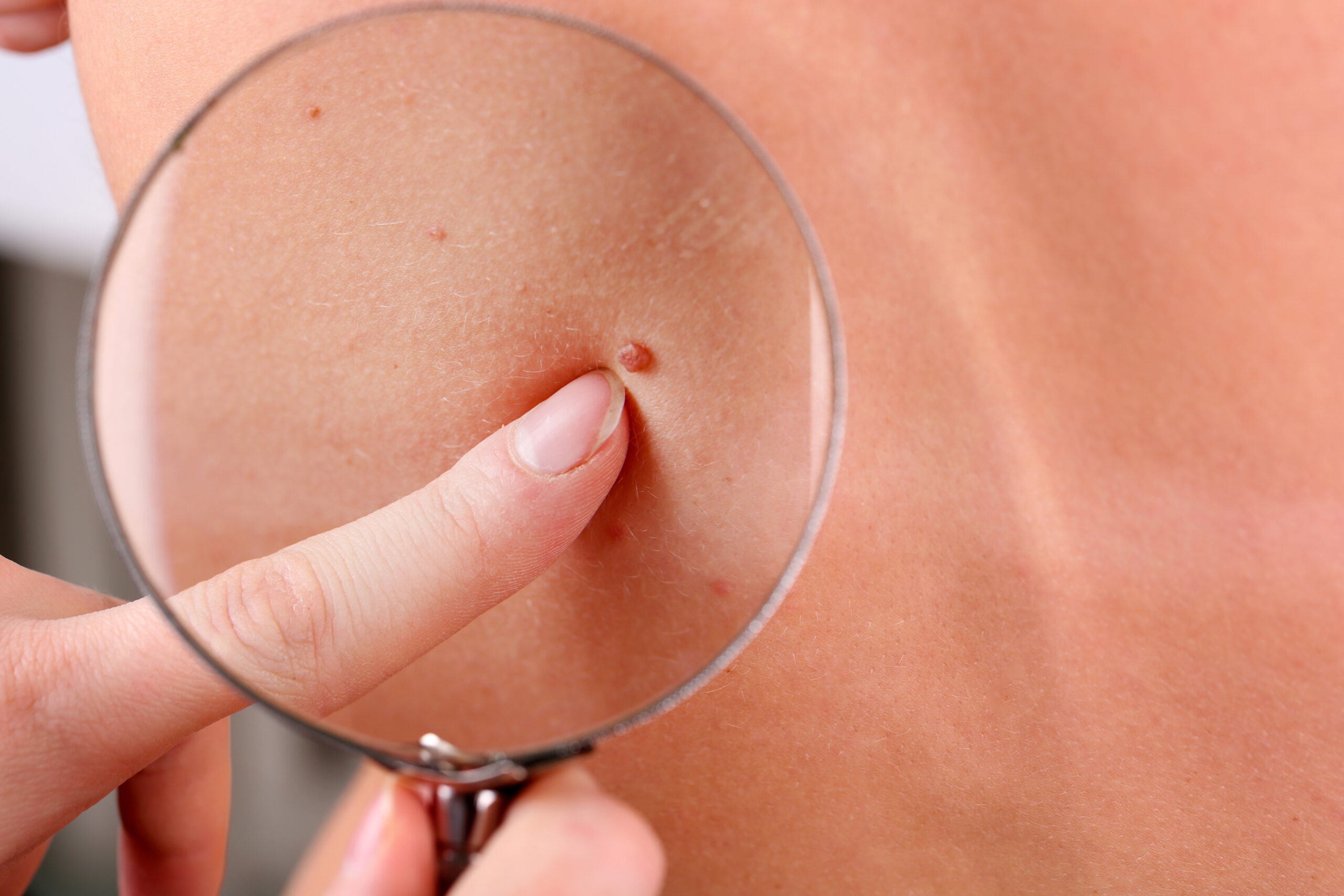 Dermatolog sprawdzający za pomocą lupy pieprzyki na ciele pacjenta.