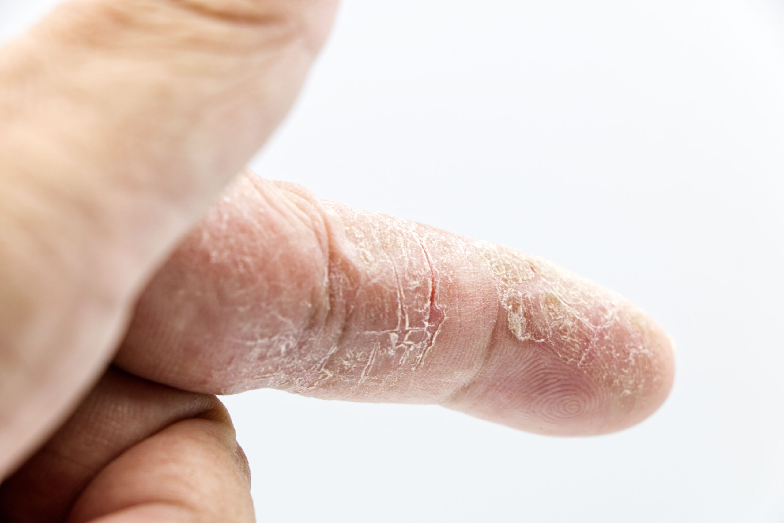 Trockene, schuppige, leicht rissige Haut am Finger als Folge von Kontaktdermatitis