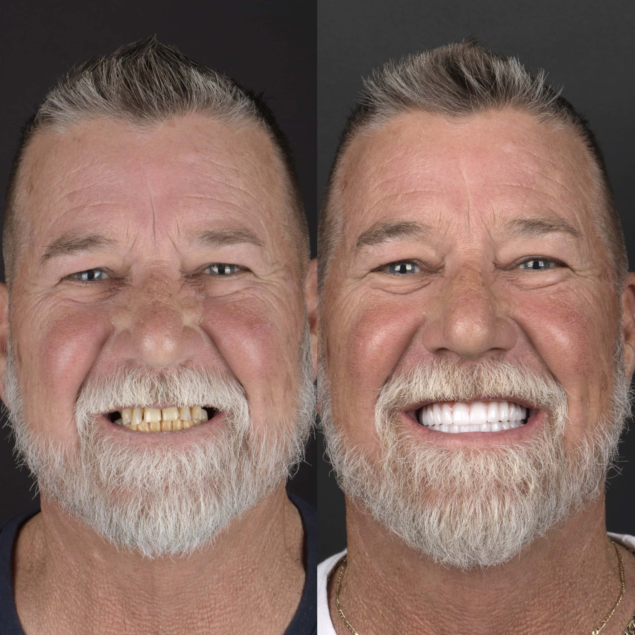 Invisalign In Austin, TX