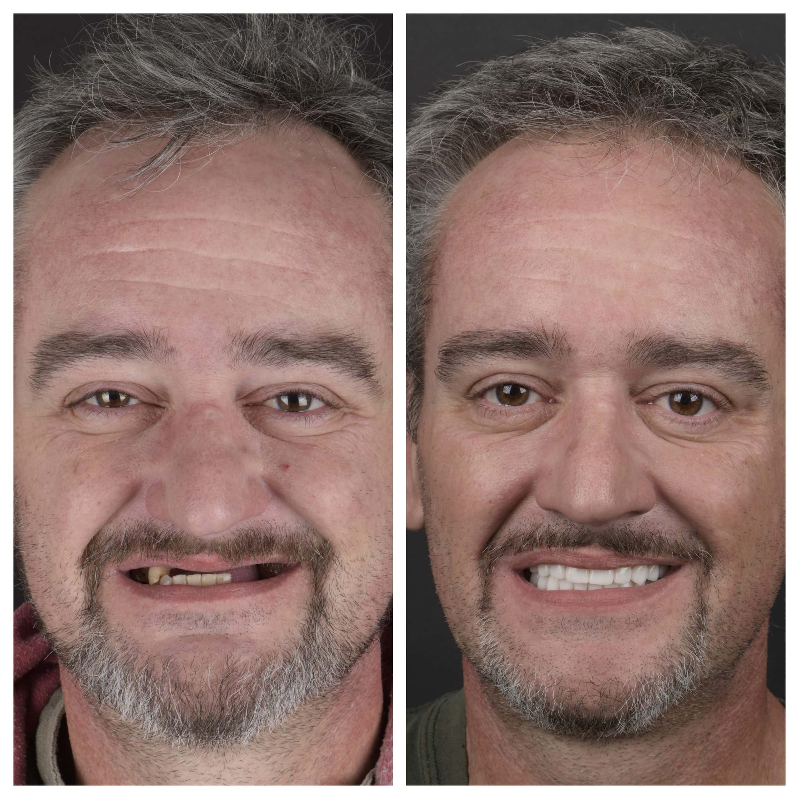 Invisalign In Austin, TX