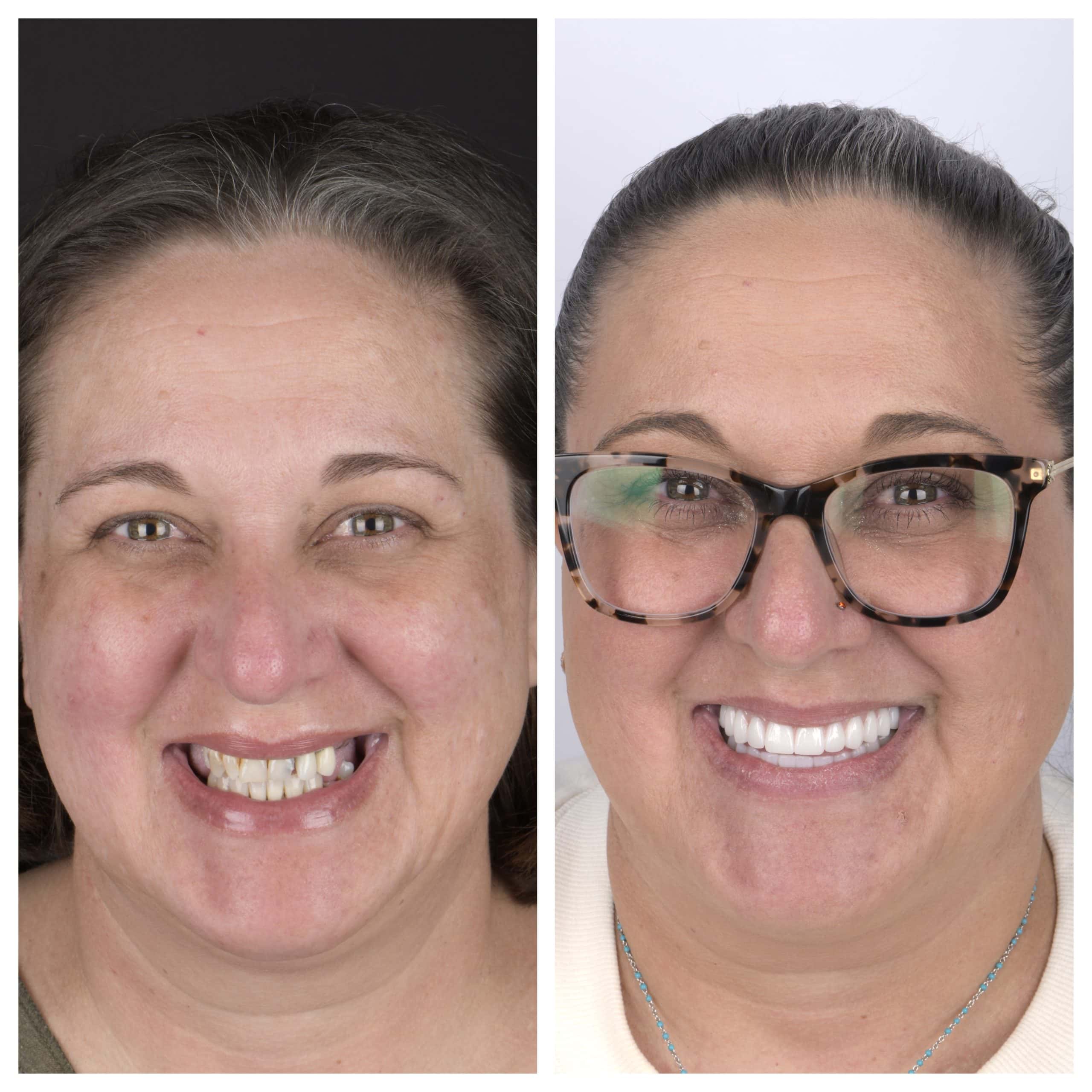 Invisalign In Austin, TX