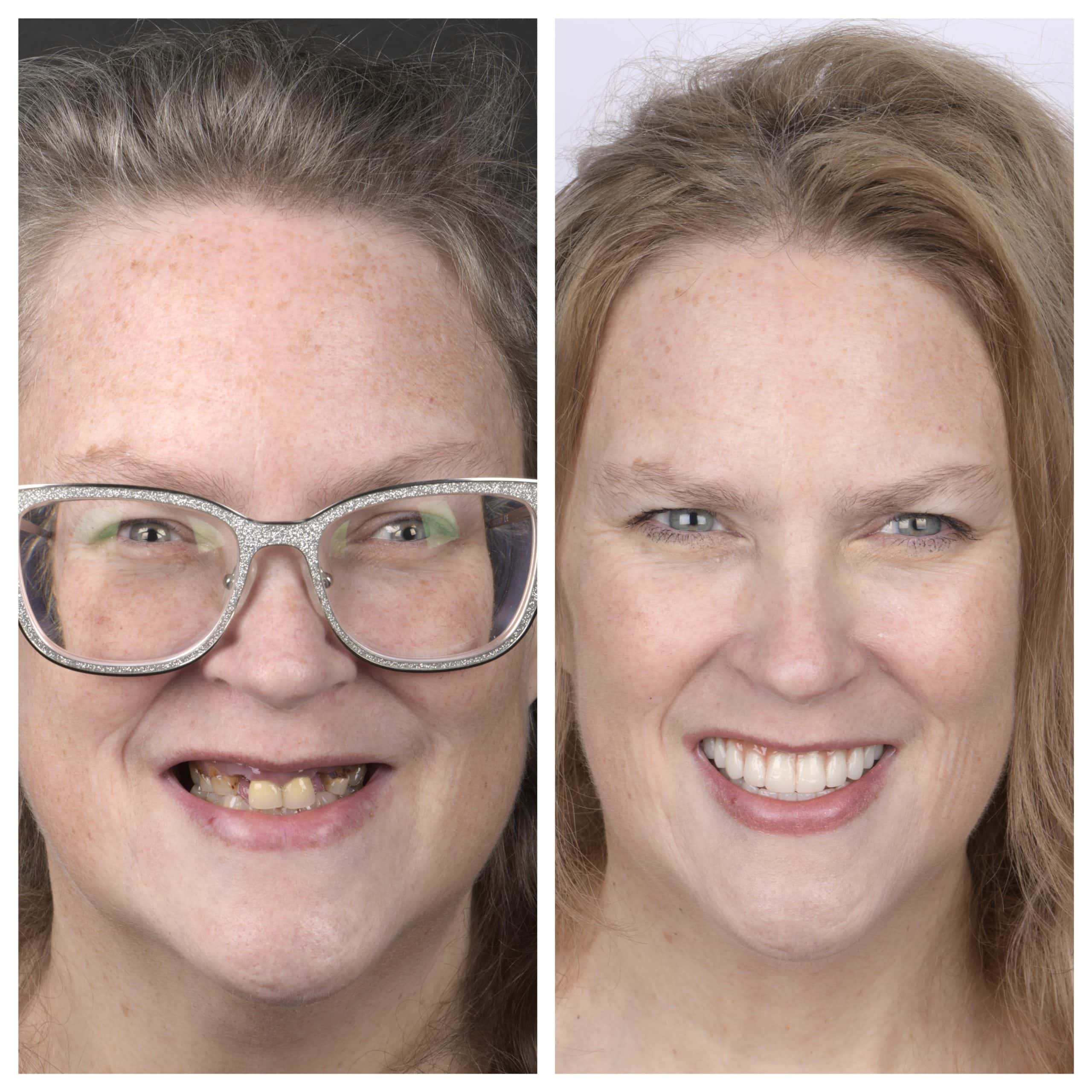 Invisalign In Austin, TX