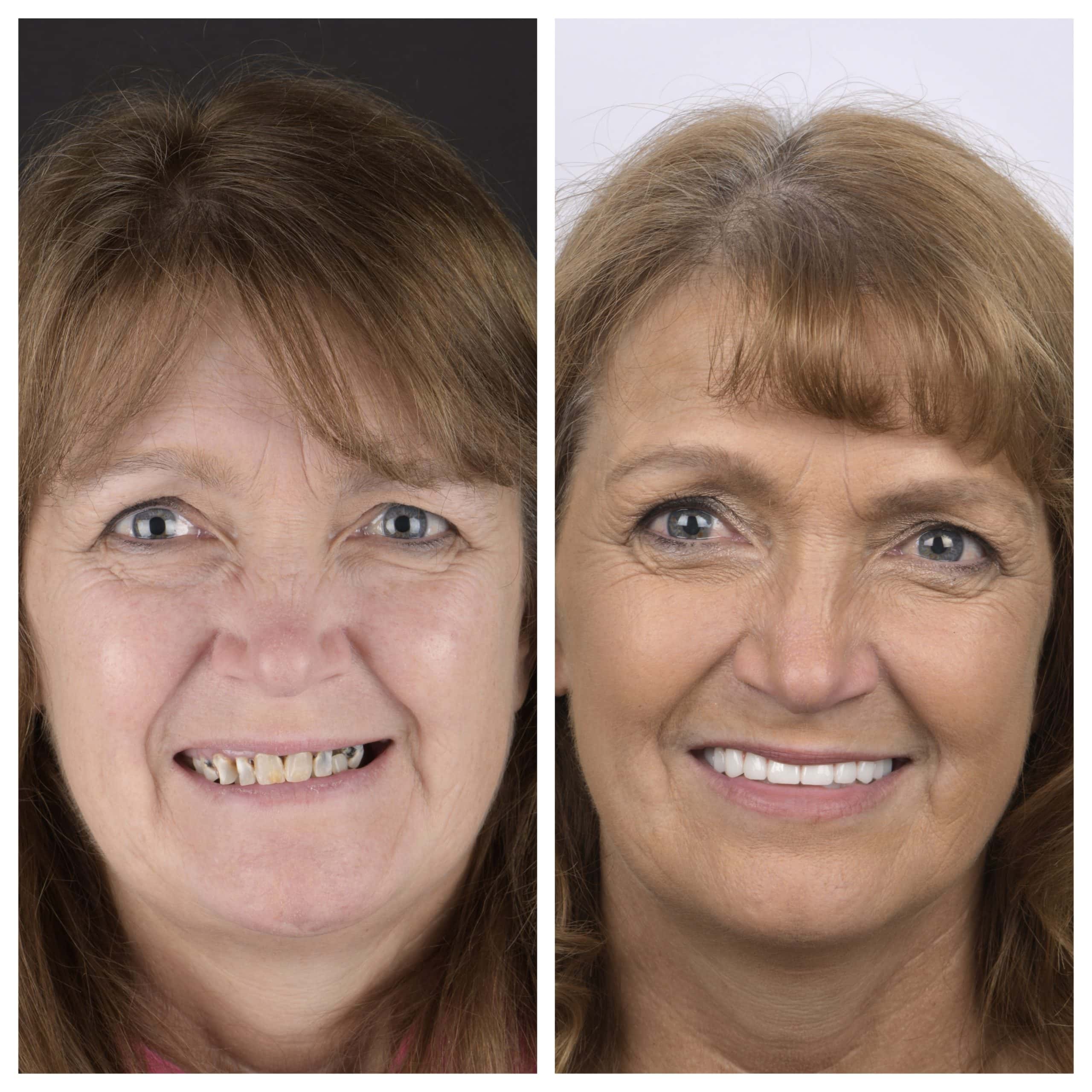 Dental implants in Austin TX