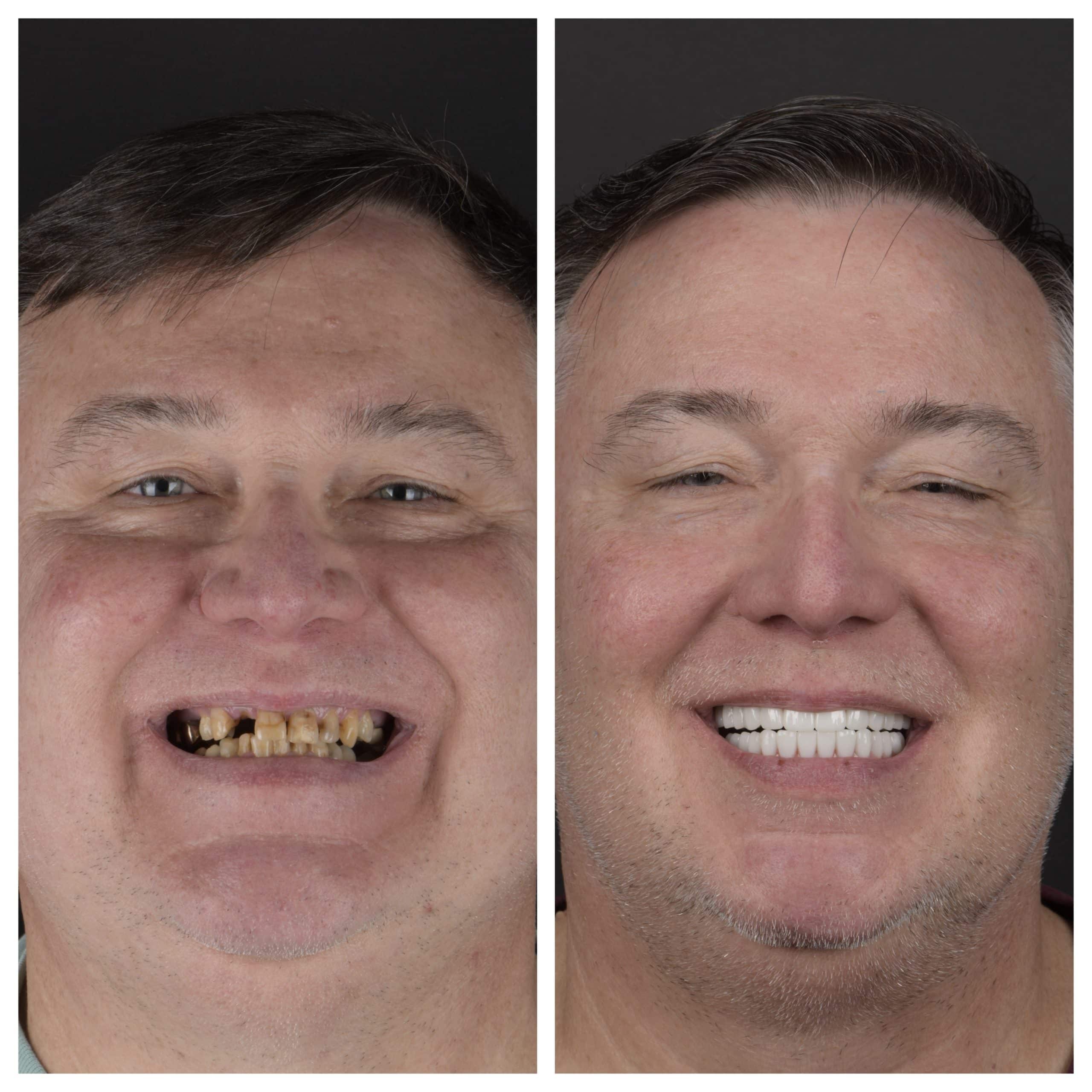 Dental implants in Austin TX