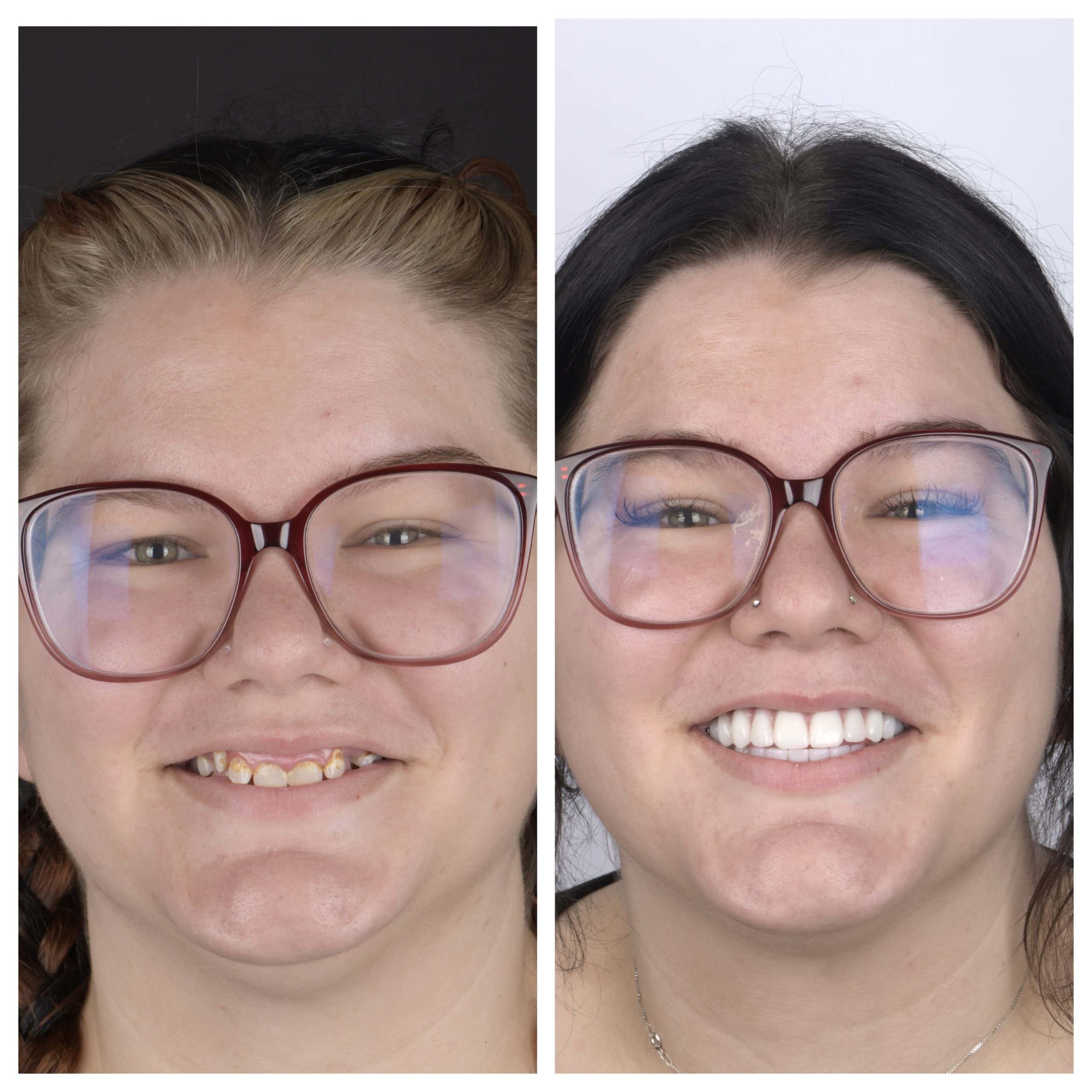 Dental implants in Austin TX