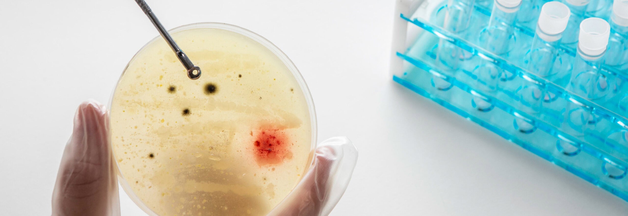 Blood In Urine (Hematuria)