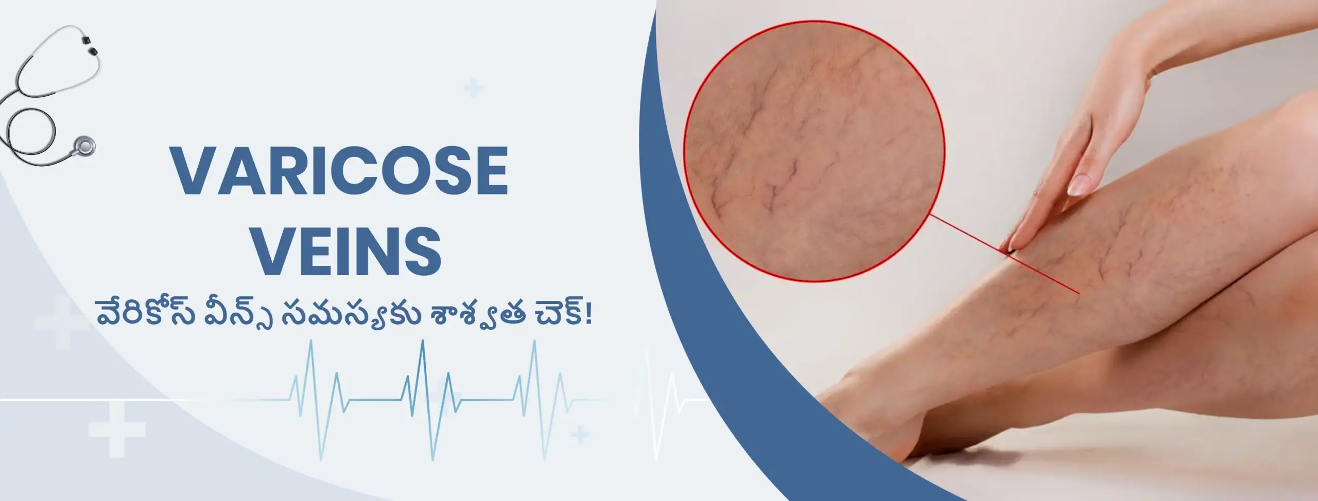 వేరికోస్ వీన్స్ సమస్యకు శాశ్వత చెక్!