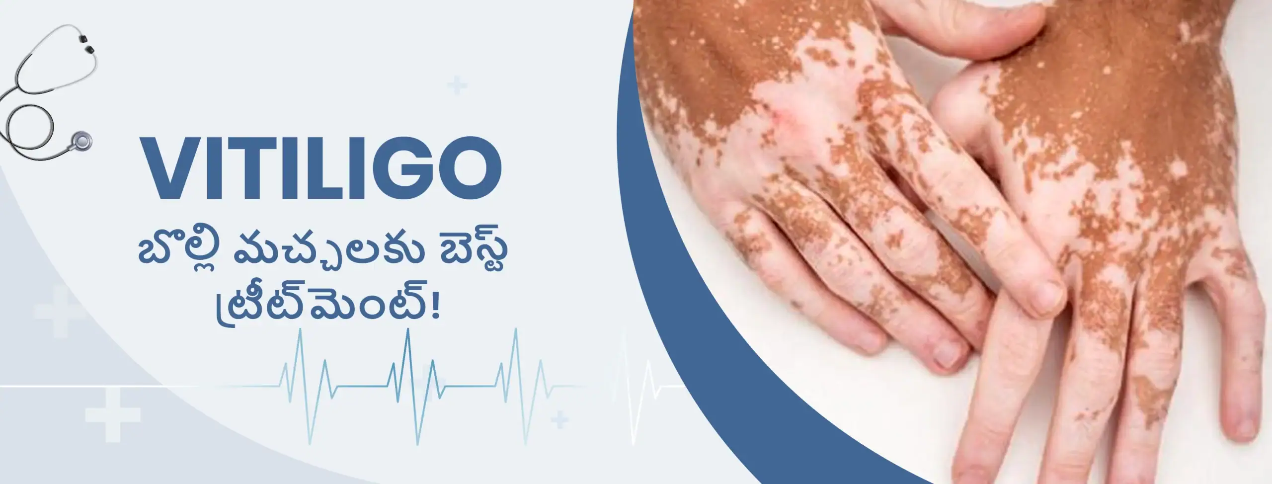 బొల్లి మచ్చలకు బెస్ట్ ట్రీట్_మెంట్!