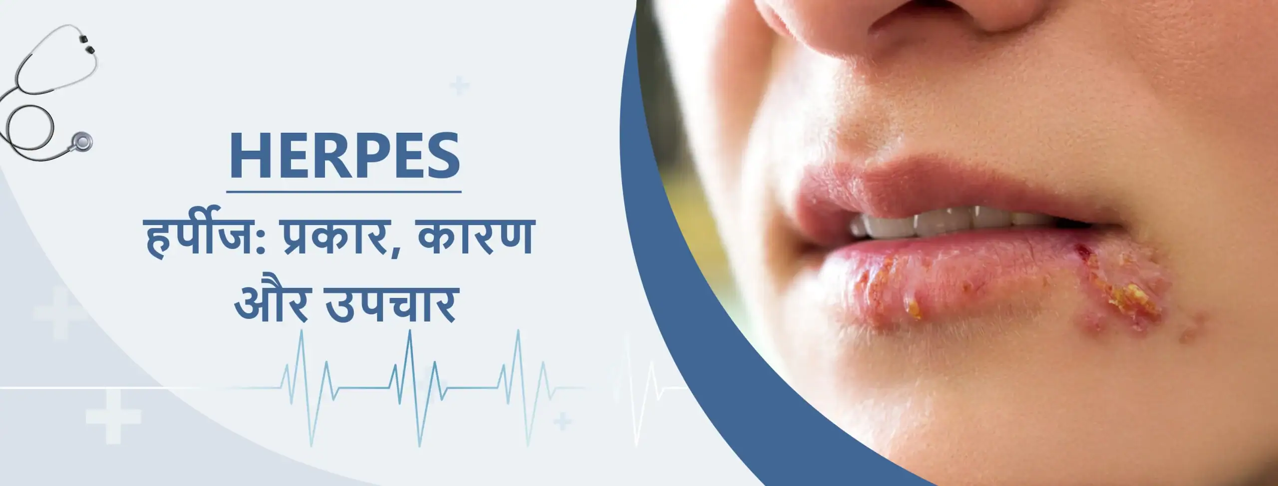 हर्पीज प्रकार, कारण और उपचार