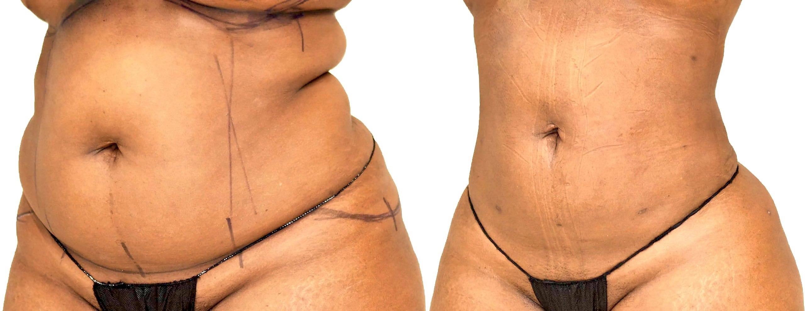 Lipo 360 before and after, Dr. Nathan Long, Dallas