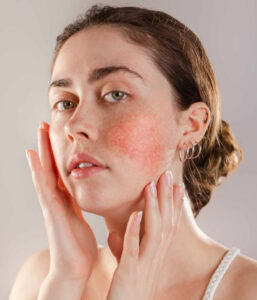 a woman with rosacea touches her face