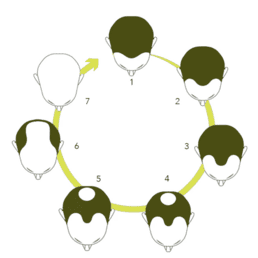 scalp micropigmentation Coventry