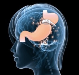 La pose d'un anneau gastrique virtuel par l'hypnose