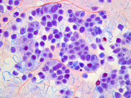 Lymphome folliculaire