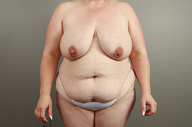 woman before getting a tummy tuck 1