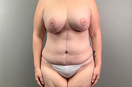 after tummy tuck 1537