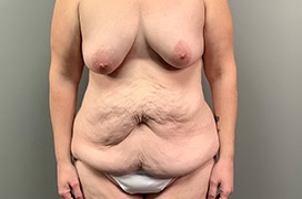 before tummy tuck 1539