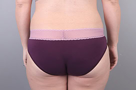 after tummy tuck 1555