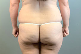before tummy tuck 1558