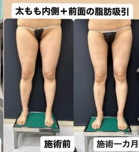 太もも脂肪吸引