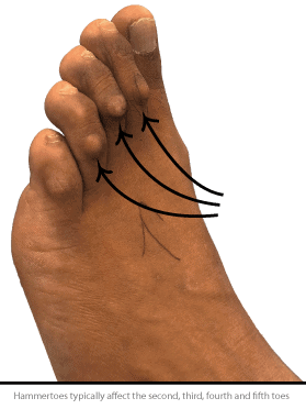 Hammer Toe Surgery before and After image