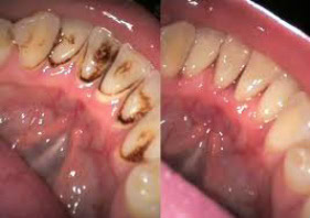 5490195 Tooth cleaning