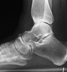 X-ray of the calcaneus (heel bone)