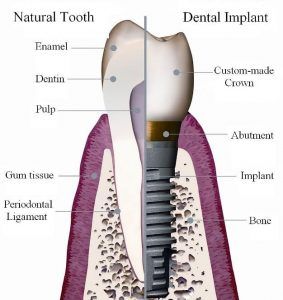 dental implant vs natural tooth dental implant vs natural tooth