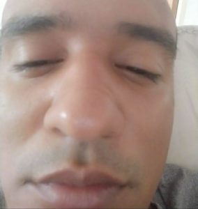 Como Curar La Conjuntivitis