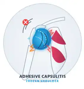 Adhesive Capsulitis (Frozen Shoulder) Treatment is being treated at prairie osteopath medical clinic Regina sK