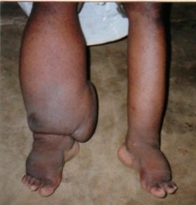 Filiriasis is the ,most common cause of lymphedema worldwide