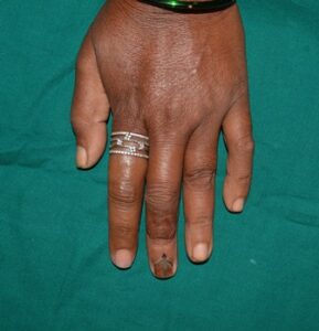 Finger Prosthesis After