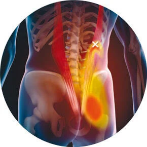 Isiász kezelése fájdalommentesen!