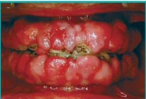 Gingivectomy-And-Gingivoplasty-Before