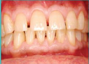 Gingivectomy-And-Gingivoplaty-After