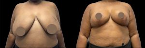 PSSVA Breast Reduction Procedures Patient 2c