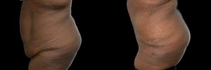 PSSVA Panniculectomy Procedures Patient 2b