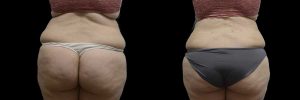 PSSVA Panniculectomy and Lipo Procedures Patient 3b