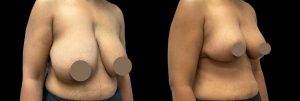 PSSVA Breast Lift Procedures Patient 4c