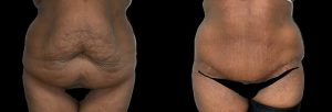 PSSVA Panniculectomy Procedures Patient 2a