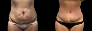 PSSVA Tummy Tuck Procedures Patient 6b