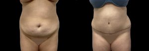 PSSVA Panniculectomy and Lipo Procedures Patient 1c