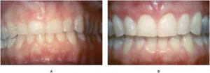 Smile_Designing___Correction_of_a_Gummy_Smile-Before___After