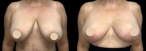 PSSVA Breast Lift Procedures Patient 6a