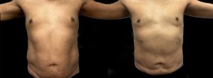 PSSVA Liposuction Procedures Patient 2d
