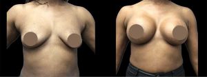 PSSVA Breast Augmenation Procedures Patient 5b