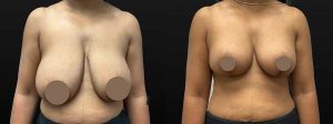 PSSVA Breast Lift Procedures Patient 4b