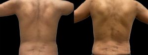 PSSVA Liposuction Procedures Patient 2a