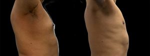 PSSVA Liposuction Procedures Patient 2c